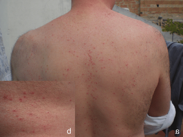 [HOT] #4 Cách Trị Ve Gà Tại Nhà Đơn Giản Và Dễ Dàng!!!